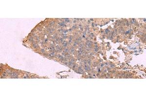 Immunohistochemistry of paraffin-embedded Human liver cancer tissue using KCNU1 Polyclonal Antibody at dilution of 1:45(x200) (KCNU1 anticorps)