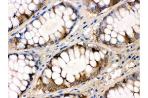Anti- liver FABP Picoband antibody,IHC(P) IHC(P): Human Intestinal Cancer Tissue