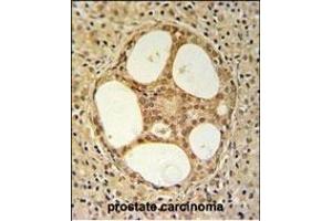 PRUNE Antibody (C-term) (ABIN653704 and ABIN2843021) IHC analysis in formalin fixed and paraffin embedded prostate carcinoma followed by peroxidase conjugation of the secondary antibody and DAB staining.