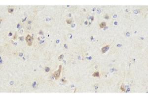 Immunohistochemistry analysis of paraffin-embedded Human brain cancer using NOS1 Polyclonal Antibody at dilution of 1:300.