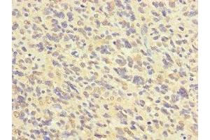 Immunohistochemistry of paraffin-embedded human glioma using ABIN7152623 at dilution of 1:100 (FABP7 anticorps  (AA 2-132))