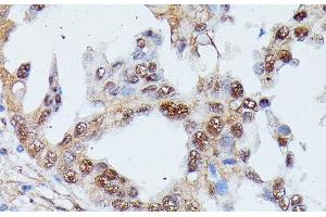Immunohistochemistry of paraffin-embedded Human lung cancer using IGHMBP2 Polyclonal Antibody at dilution of 1:100 (40x lens). (IGHMBP2 anticorps)