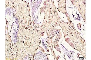 Formalin-fixed and paraffin embedded human colorectal cancer labeled with Anti-oxLDL Polyclonal Antibody, Unconjugated (ABIN733148) followed by conjugation to the secondary antibody and DAB staining (OxLDL anticorps)