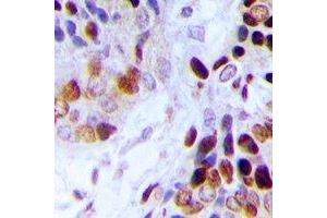 Immunohistochemical analysis of Adenylate Kinase 6 staining in human prostate cancer formalin fixed paraffin embedded tissue section.