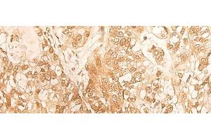 Immunohistochemistry of paraffin-embedded Human gastric cancer tissue using DBP Polyclonal Antibody at dilution of 1:25(x200) (DBP anticorps)