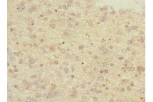 Immunohistochemistry of paraffin-embedded human glioma using ABIN7166554 at dilution of 1:100 (Protocadherin 1 anticorps  (AA 515-715))