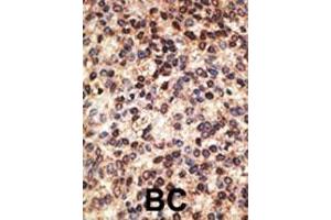 Formalin-fixed and paraffin-embedded human cancer tissue reacted with the primary antibody, which was peroxidase-conjugated to the secondary antibody, followed by DAB staining.