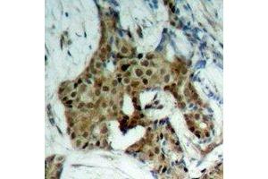 Immunohistochemical analysis of STAT1 (pY701) staining in human breast cancer formalin fixed paraffin embedded tissue section. (STAT1 anticorps  (C-Term, pTyr701))