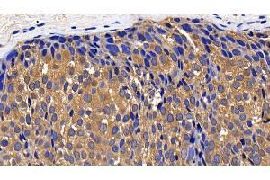 Detection of CTSK in Human Breast cancer Tissue using Polyclonal Antibody to Cathepsin K (CTSK) (Cathepsin K anticorps  (AA 54-317))