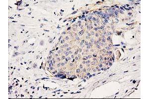 Immunohistochemical staining of paraffin-embedded Adenocarcinoma of Human breast tissue using anti-BCAR1 mouse monoclonal antibody. (BCAR1 anticorps)