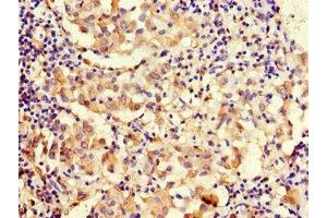 Immunohistochemistry of paraffin-embedded human lung cancer using ABIN7159746 at dilution of 1:100 (MAP1 anticorps  (AA 401-600))