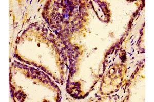 Immunohistochemistry of paraffin-embedded human prostate cancer using ABIN7147997 at dilution of 1:100 (F12 anticorps  (AA 486-600))