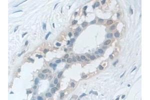 Detection of VCP in Human Breast cancer Tissue using Polyclonal Antibody to Valosin Containing Protein (VCP)