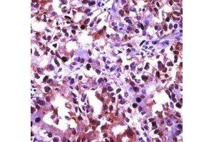 HSF1 antibody immunohistochemistry analysis in formalin fixed and paraffin embedded human kidney carcinoma.