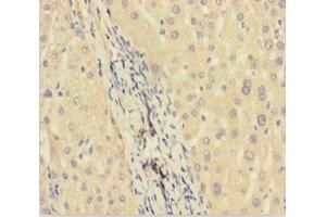 Immunohistochemistry of paraffin-embedded human liver cancer using ABIN7165631 at dilution of 1:100 (C11orf73 anticorps  (AA 1-197))