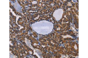 Immunohistochemistry of Human lung cancer using ADRBK2 Polyclonal Antibody at dilution of 1:50