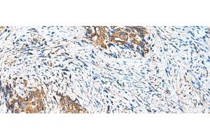 Immunohistochemistry of paraffin-embedded Human cervical cancer tissue using CAMSAP3 Polyclonal Antibody at dilution of 1:110(x200) (CAMSAP3 anticorps)