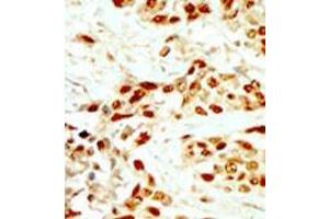 Formalin-fixed and paraffin-embedded human cancer tissue (breast carcinoma) reacted with the primary antibody, which was peroxidase-conjugated to the secondary antibody, followed by DAB staining.