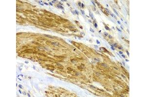 Immunohistochemistry of paraffin-embedded Human gastric cancer using CDK6 Polyclonal Antibody at dilution of 1:100 (40x lens). (CDK6 anticorps)