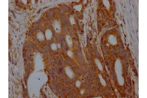 IHC image of ABIN7127334 diluted at 1:100 and staining in paraffin-embedded human colon cancer performed on a Leica BondTM system.
