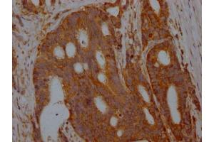IHC image of ABIN7127334 diluted at 1:100 and staining in paraffin-embedded human colon cancer performed on a Leica BondTM system. (Recombinant ALDOA anticorps)