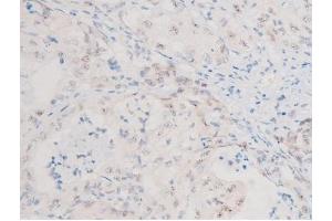 ABIN6267579 at 1/200 staining Human liver cancer tissue sections by IHC-P.