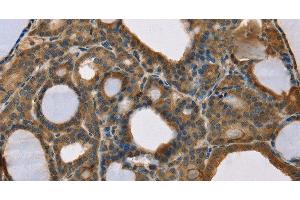 Immunohistochemistry of paraffin-embedded Human thyroid cancer using SCGB2A1 Polyclonal Antibody at dilution of 1:50 (SCGB2A1 anticorps)