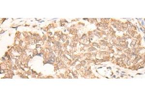 Immunohistochemistry of paraffin-embedded Human lung cancer tissue using EMSY Polyclonal Antibody at dilution of 1:25(x200) (EMSY anticorps)