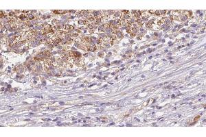 ABIN6272645 at 1/100 staining Human liver cancer tissue by IHC-P. (CD235a/GYPA anticorps  (Internal Region))