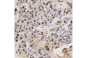 Immunohistochemistry of paraffin-embedded human esophageal cancer using KPNA4 Antibody.