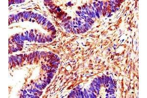 Immunohistochemistry of paraffin-embedded human ovarian cancer using ABIN7170549 at dilution of 1:100