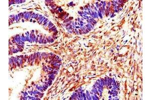 Immunohistochemistry of paraffin-embedded human ovarian cancer using ABIN7170549 at dilution of 1:100 (SMS anticorps  (AA 16-191))