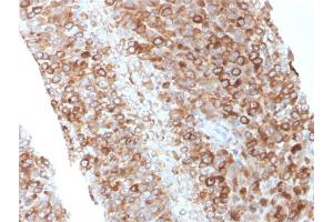 Formalin-fixed, paraffin-embedded human Melanoma stained with CD63 Mouse Monoclonal Antibody (LAMP3/2881) (CD63 anticorps  (AA 100-197))