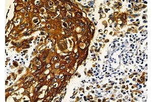 ABIN6262729 and ABIN6278925 at 1/100 staining human esophageal cancer by IHC-P. (Keratin 6 anticorps  (C-Term))