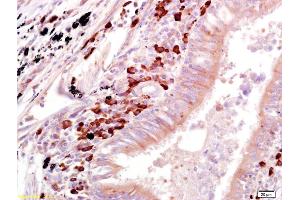 Formalin-fixed and paraffin embedded human lung carcinoma labeled with Anti-OAS1 Polyclonal Antibody, Unconjugated (ABIN671931) at 1:200 followed by conjugation to the secondary antibody and DAB staining (OAS1 anticorps)