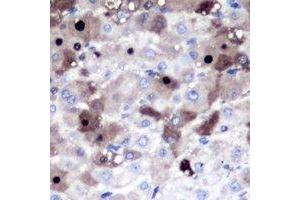 Immunohistochemical analysis of PSMD8 staining in human liver cancer formalin fixed paraffin embedded tissue section. (PSMD8 anticorps)