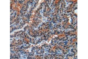 Detection of RXFP1 in Human Thyroid Cancer Tissue using Polyclonal Antibody to Relaxin/Insulin Like Family Peptide Receptor 1 (RXFP1)