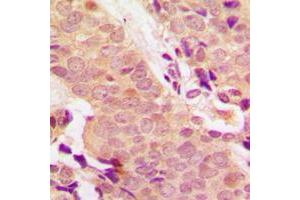 Immunohistochemical analysis of STAT5 (pY694/699) staining in human breast cancer formalin fixed paraffin embedded tissue section. (STAT5A anticorps  (C-Term, pTyr694, pTyr699))