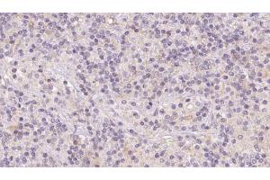 ABIN6273121 at 1/100 staining Human lymph cancer tissue by IHC-P. (Hemoglobin, epsilon 1 (HBe1) anticorps)