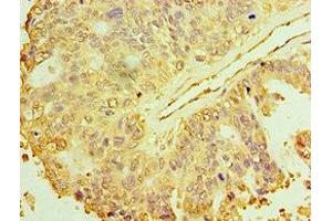 Immunohistochemistry of paraffin-embedded human endometrial cancer using ABIN7150706 at dilution of 1:100