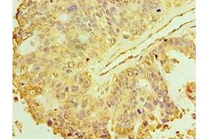 Immunohistochemistry of paraffin-embedded human endometrial cancer using ABIN7150706 at dilution of 1:100 (MAP2K3 anticorps  (AA 1-170))