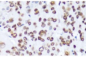 Immunohistochemistry of paraffin-embedded Human liver cancer using Phospho-ABL1(Y245) Polyclonal Antibody at dilution of 1:100 (40x lens).