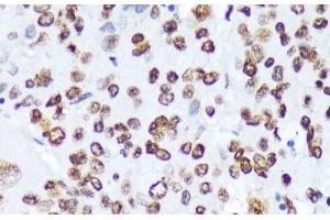 Immunohistochemistry of paraffin-embedded Human liver cancer using Phospho-ABL1(Y245) Polyclonal Antibody at dilution of 1:100 (40x lens). (ABL1 anticorps  (pTyr245))