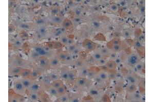 DAB staining on IHC-P; Samples: Human Liver cancer Tissue