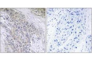 Immunohistochemistry analysis of paraffin-embedded human breast carcinoma, using BCL-2 (Phospho-Thr56) Antibody. (Bcl-2 anticorps  (pThr56))