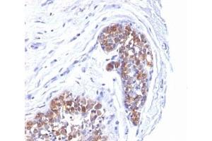Formalin-fixed, paraffin-embedded human breast carcinoma stained with MUC-1 antibody.
