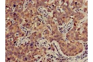 Immunohistochemistry of paraffin-embedded human pancreatic cancer using ABIN7149950 at dilution of 1:100 (TFB2M anticorps  (AA 30-108))