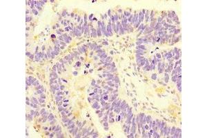 Immunohistochemistry of paraffin-embedded human ovarian cancer using ABIN7170745 at dilution of 1:100 (SAMD7 anticorps  (AA 1-300))