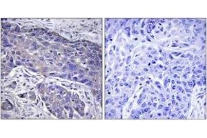 Immunohistochemistry analysis of paraffin-embedded human lung carcinoma tissue, using POFUT1 Antibody. (POFUT1 anticorps  (AA 331-380))