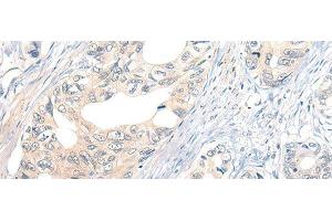 Immunohistochemistry of paraffin-embedded Human gastric cancer tissue using NOG Polyclonal Antibody at dilution of 1:50(x200)